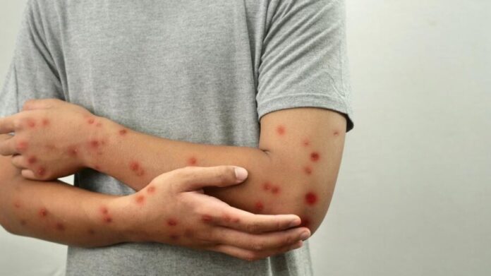 mpox