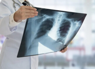 Radiologistas deflagram greve e crise na saúde do Amazonas se agrava